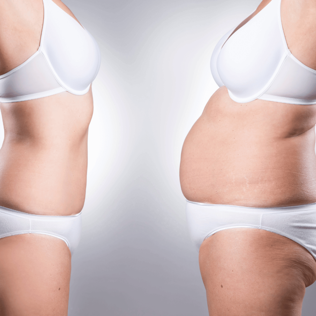 Bodcor Body Contouring for Weight Loss